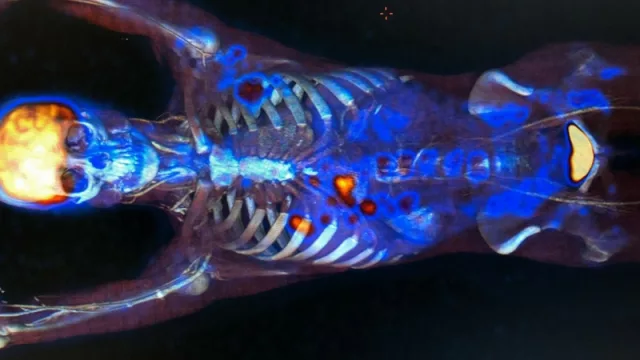 Llegó a Tucumán un estudio que cambiará el diagnóstico y el tratamiento del cáncer